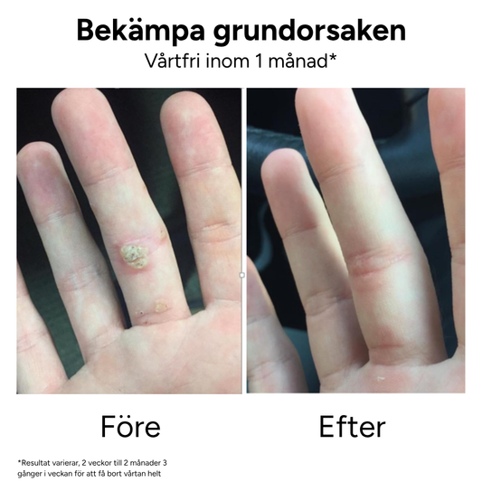Vårtborttagningskit | Teträdolja + Plåster