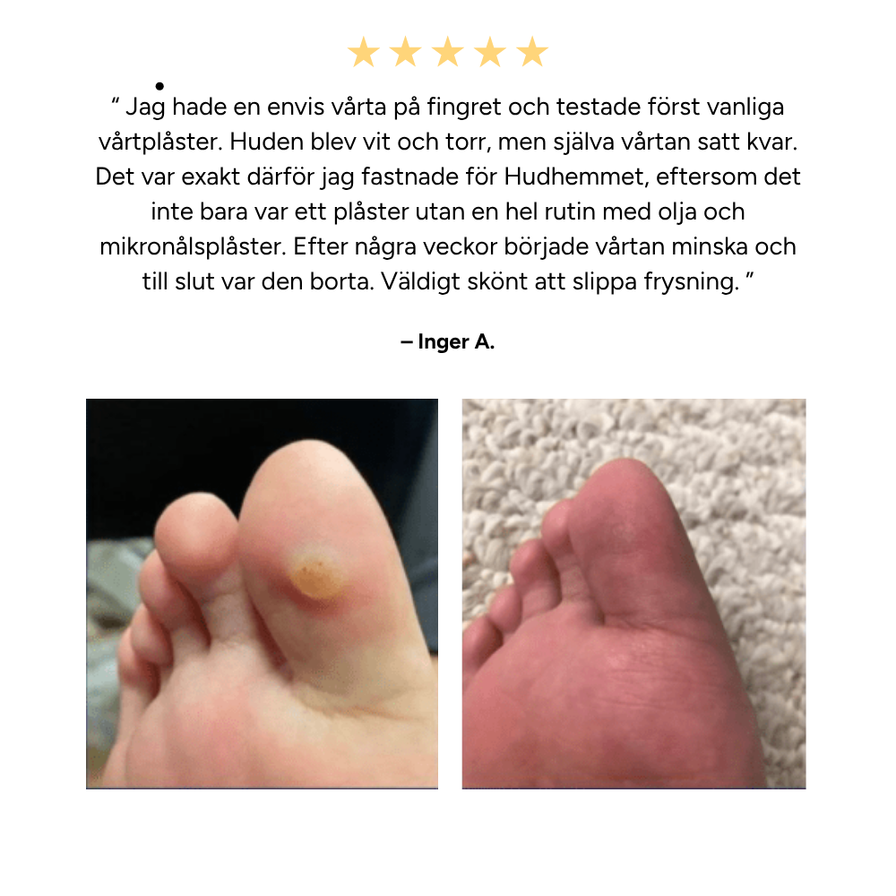 Vårtborttagningskit | Teträdolja + Plåster
